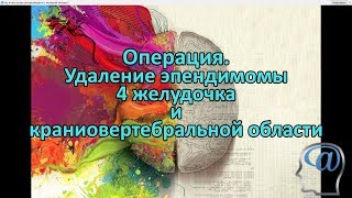 Операция. Удаление опухоли (эпендимомы) 4 желудочка и краниовертебральной области