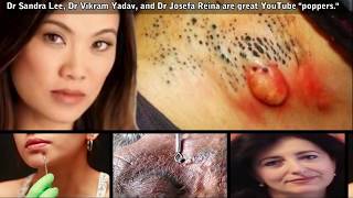 Pimple Popping 101!  Biggest Dilated Pores, Best Pimples & Largest Comedones