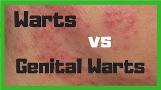 What's the Difference between Warts and Genital Warts?