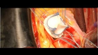 Протезирование аортального клапана сердца биопротезом ЮниЛайн. Aortic HVR with UniLine bioprosthesis
