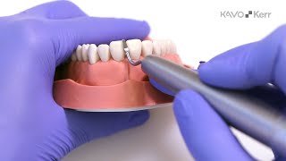 SONICflex Stripping/Shaping Spitzen – Klinisches Fallbeispiel Nr. 2