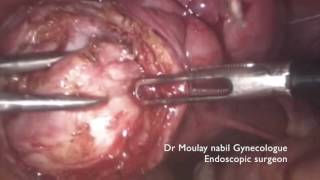 Laparoscopic myomectomy before IVF procedure