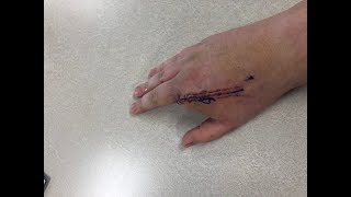 Seeing My Hand After Finger Amputation