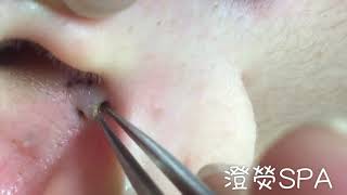 清粉刺耳朵粉刺