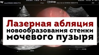 Лазерная абляция новообразования стенки мочевого пузыря