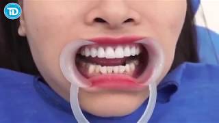 Dán Venner Tại Biên Hòa - Nha Khoa Uy Tín Biên Hòa