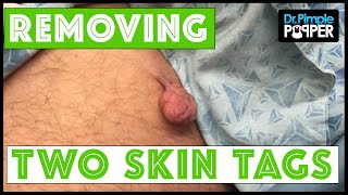 Two Skin Tags Removed on the Thighs