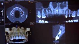 Implant Consultation with the CS 9300