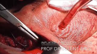 STEP BY STEP INFLATABLE PENILE PROSTHESIS  SURGERY