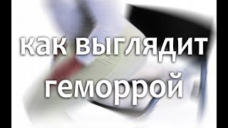 Как выглядит геморрой у женщин и у мужчин, начальная стадия