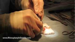 How to fix an short, up-turned nose with rib cartilage | Seattle Revision Rhinoplasty Surgeon