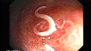 Colonoscopy: Moving Parasites