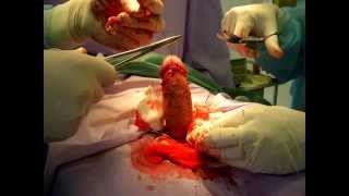 Циркумцизия. Оперирует доктор Горохов. dr-gorohov.ru