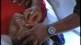 William Nonog, Psychic Surgery, Geistheiler