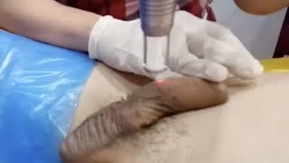 Genital Skin Whitening Laser Treatment @  KL