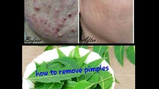**| How to remove pimples and acne from face hands and back| 100% effective results|**