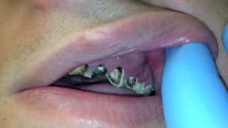 dental abscess