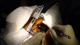 Proximal anastomosis : MICS CABG via 5th Inter Costal Space