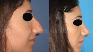 Rhinoplasty Քթի պլաստիկ վիրահատություն Пластика носа