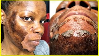 CHEMICAL PEEL EXPERIENCE| 15% & 25% TCA PEEL (GRAPHIC IMAGES)