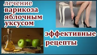 избавляемся от варикоза с помощью яблочного уксуса.