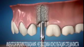 Имплантация зубов стоматология Жемчужина на Салмышской
