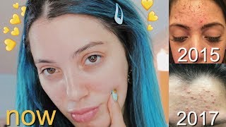 My ~Effective~ Skincare Routine After YEARS of Acne