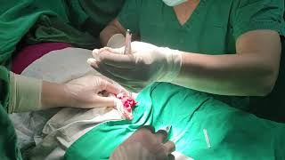 II Generation Langhe Circumcision Surgery China Vlog By Dr.Kuber Call +919370275336