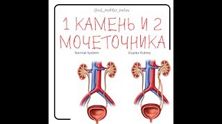 УЗИ почек и мочевого пузыря  - 1 камень и 2 мочеточника