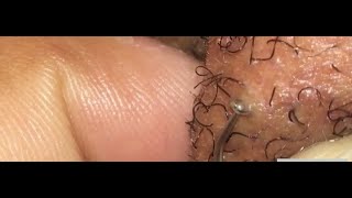 Ingrown hairs part 6/Subscribe for a chance to win a Target gift card!