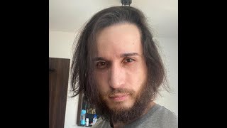 6 meses após a cirurgia,  Jader mostra seu Transplante Capilar.