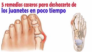 5 remedios caseros para deshacerte de los juanetes en poco tiempo