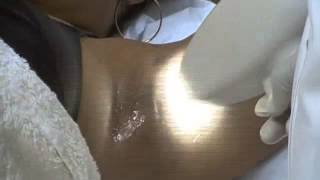 The Most Effective Laser Hair Removal on Dark Skin