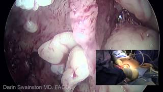 Dual view of uterine extraction