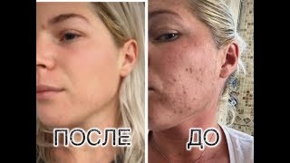 КАРБОКСИТЕРАПИЯ: Омоложение лица углекислым газом, БЕЗИНЪЕКЦИОННАЯ