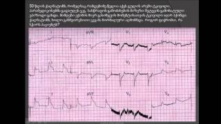 პრინცმეტალის სტენოკარდია (ვარიანტული სტენოკარდია) / კორონარული არტერიების სპაზმი / ანგიოგრაფია