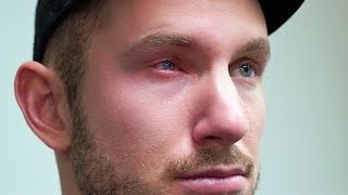 Shot In The Eye With NERF!