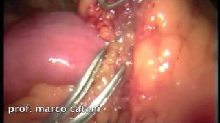 Trattamento laparoscopico di due casi di occlusione intestinale da briglia