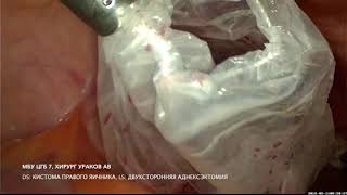 Кистома правого яичника. Лапароскопическая аднексэктомия.