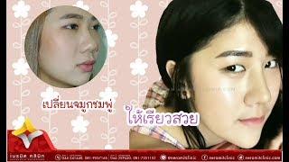 เสริมจมูก EP.14 /เปลี่ยนจมูกชมพู่ ให้เรียว สวย @หมอปุ๊ Neramit Clinic