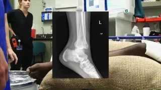 Ankle Fracture Dislocation Reduction