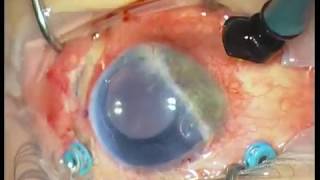 Chronic retinal detachment and dislocated iris IOL