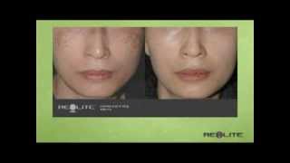 RevLite Laser Nashville, TN - Dr. J. J. Wendel Plastic Surgery