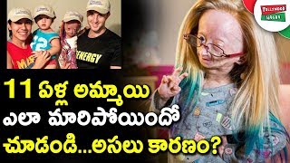 Adalia Rose 11 Year Old Girl Who Ages Too Fast And Becomes Internet Superstar | US Girl Adalia Rose