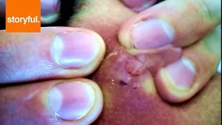 Man Pops All Of His Big Pimples On Camera (Storyful, Crazy)