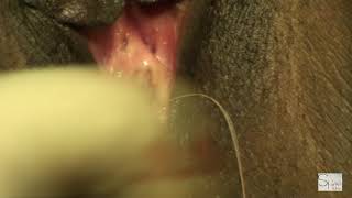 Hymenoplasty Surgical Technique