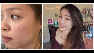 Review Sản Phẩm Trị Thâm Mụn Hiệu Quả - How to Get Rid Of Acne Scars | TrinhPham