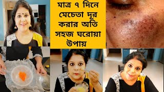 মাত্র ৭দিনে মেচেতা থেকে মুক্তি।।অতি সহজ ঘরোয়া উপায়ে দূর করো মেচেতার দাগ।।Get rid of Pigmentation।।