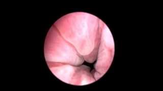Цистоскопия. Переходноклеточный рак. (Cystoscopy. Transitional cell cancer.)