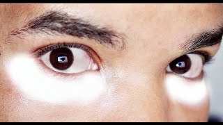 Under-Eye 25% TCA Peel | Application + Results | Session #1